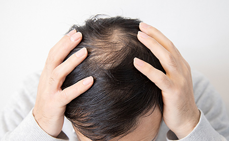 薄毛は確実に進行します